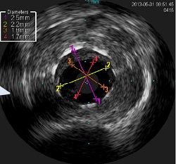 IVUSを用いた血管計測画像