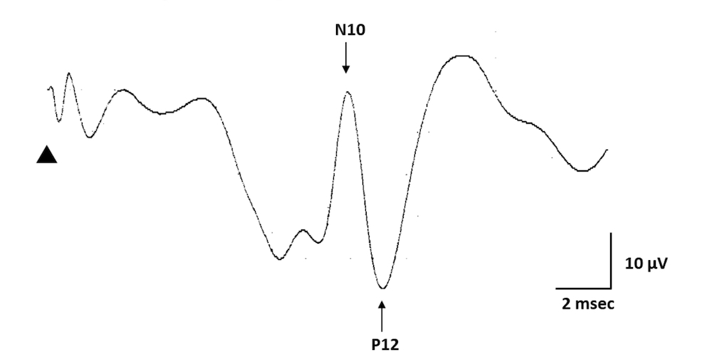 運動誘発電位 (MEP) 検査にはリスクがありますか?